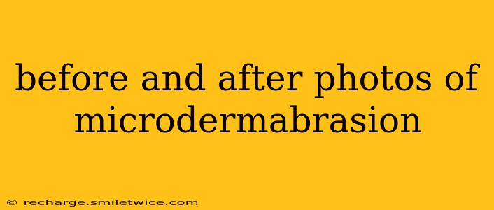 before and after photos of microdermabrasion