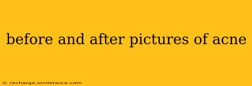 before and after pictures of acne