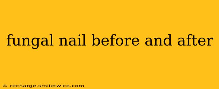 fungal nail before and after