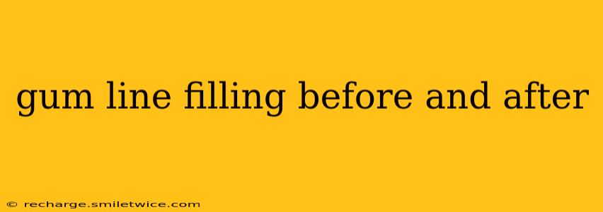 gum line filling before and after
