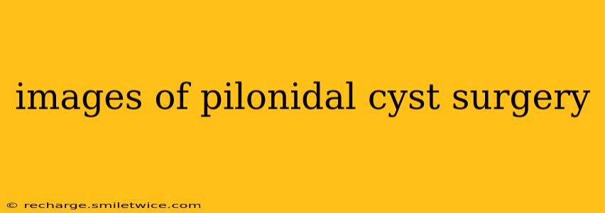 images of pilonidal cyst surgery