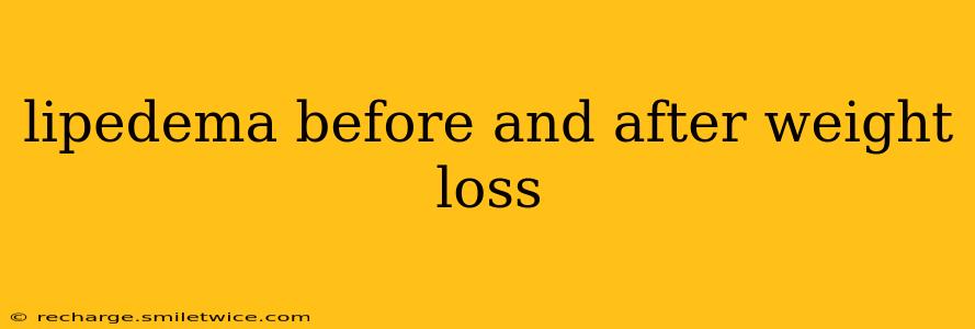 lipedema before and after weight loss