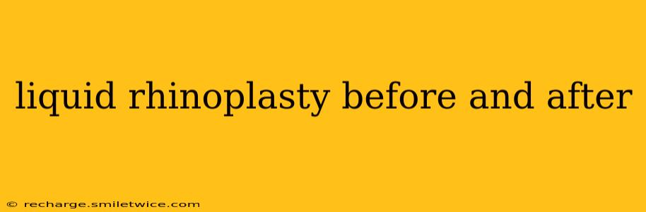 liquid rhinoplasty before and after