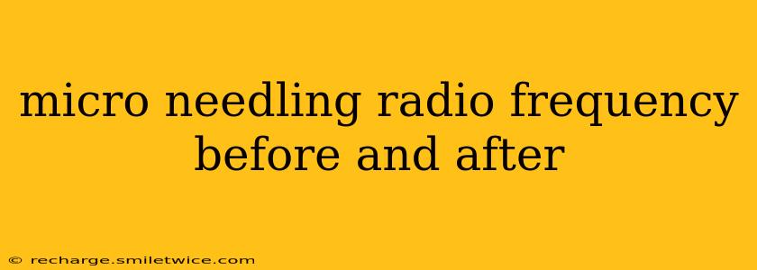 micro needling radio frequency before and after