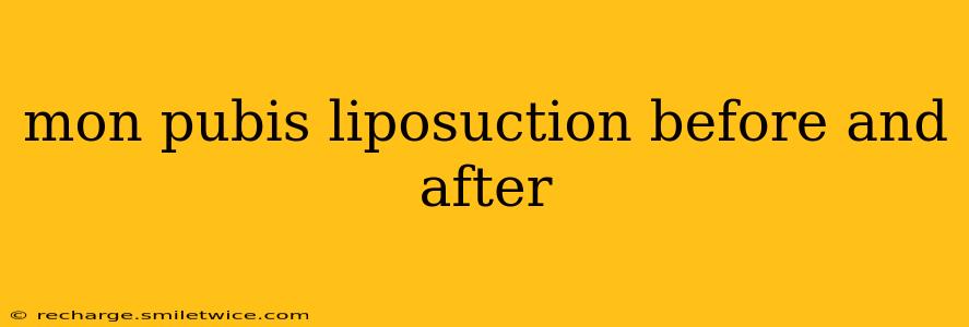 mon pubis liposuction before and after