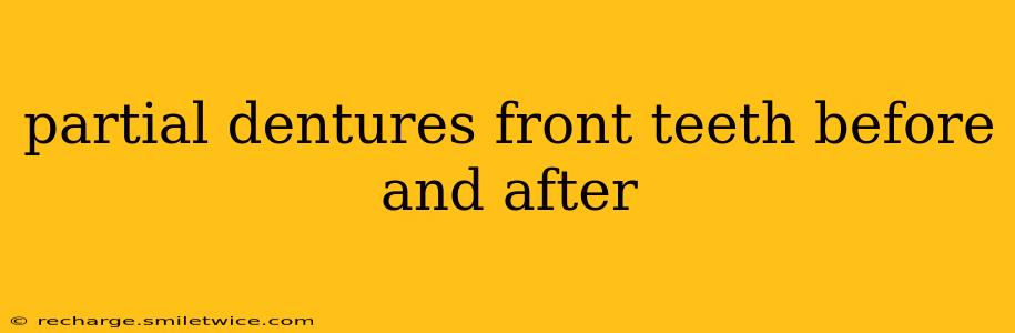 partial dentures front teeth before and after