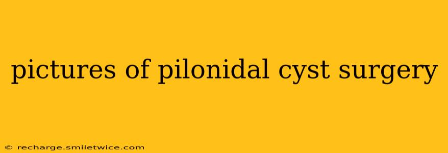 pictures of pilonidal cyst surgery