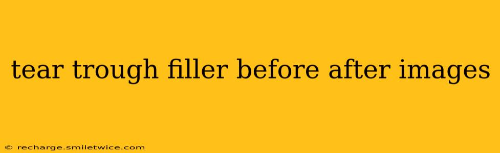 tear trough filler before after images