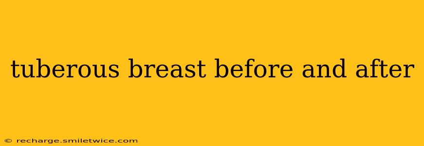 tuberous breast before and after