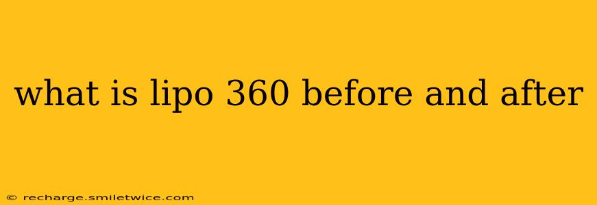 what is lipo 360 before and after